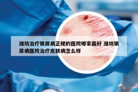 濰坊治療銀屑病正規(guī)的醫(yī)院哪家最好 濰坊銀屑病醫(yī)院治療皮膚病怎么樣