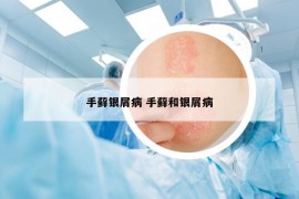 手蘚銀屑病 手蘚和銀屑病