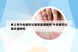 身上有牛皮癬可以用斑蝥酒擦嗎 牛皮癬可以用白酒擦嗎
