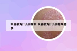 銀屑病為什么會(huì)掉屑 銀屑病為什么會(huì)越來(lái)越多