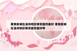 看銀屑病在溫州地區(qū)哪家醫(yī)院最好 看銀屑病在溫州地區(qū)哪家醫(yī)院最好呢