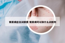 銀屑病適合潤膚露 銀屑病可以抹什么潤膚劑