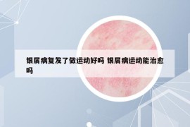 銀屑病復發(fā)了做運動好嗎 銀屑病運動能治愈嗎