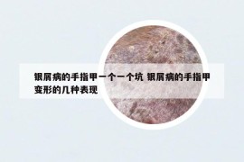 銀屑病的手指甲一個一個坑 銀屑病的手指甲變形的幾種表現(xiàn)