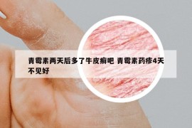 青霉素兩天后多了牛皮癬吧 青霉素藥疹4天不見(jiàn)好