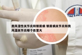 類風濕性關節(jié)炎和銀屑病 銀屑病關節(jié)炎和類風濕關節(jié)炎哪個危害大