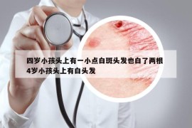 四歲小孩頭上有一小點(diǎn)白斑頭發(fā)也白了兩根 4歲小孩頭上有白頭發(fā)