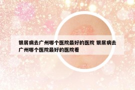 銀屑病去廣州哪個醫(yī)院最好的醫(yī)院 銀屑病去廣州哪個醫(yī)院最好的醫(yī)院看
