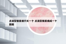 點(diǎn)滴型銀屑病只長(zhǎng)一個(gè) 點(diǎn)滴型銀屑病成一個(gè)圓圈