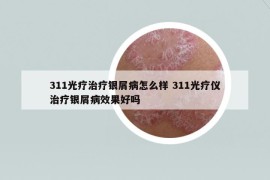 311光療治療銀屑病怎么樣 311光療儀治療銀屑病效果好嗎