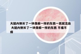 大腿內(nèi)側(cè)長(zhǎng)了一塊像癬一樣的東西一抓就流血 大腿內(nèi)側(cè)長(zhǎng)了一塊像癬一樣的東西 不痛不癢