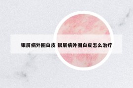 銀屑病外圈白皮 銀屑病外圈白皮怎么治療