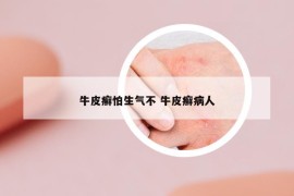 牛皮癬怕生氣不 牛皮癬病人