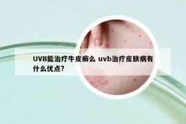 UVB能治療牛皮癬么 uvb治療皮膚病有什么優(yōu)點?