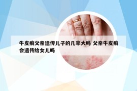 牛皮癬父親遺傳兒子的幾率大嗎 父親牛皮癬會遺傳給女兒嗎
