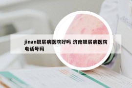 jinan銀屑病醫(yī)院好嗎 濟(jì)南銀屑病醫(yī)院電話號(hào)碼