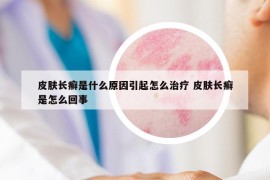 皮膚長(zhǎng)癬是什么原因引起怎么治療 皮膚長(zhǎng)癬是怎么回事
