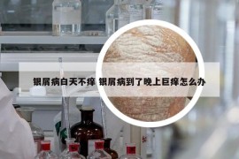 銀屑病白天不癢 銀屑病到了晚上巨癢怎么辦