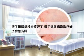 得了銀屑病沒治療好了 得了銀屑病沒治療好了會怎么樣