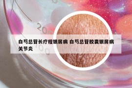 白芍總苷長療程銀屑病 白芍總苷膠囊銀屑病關(guān)節(jié)炎