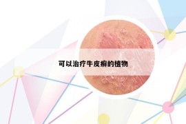 可以治療牛皮癬的植物