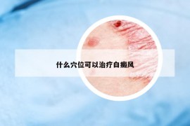 什么穴位可以治療白癜風(fēng)