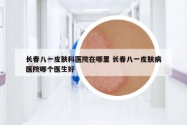 長春八一皮膚科醫(yī)院在哪里 長春八一皮膚病醫(yī)院哪個(gè)醫(yī)生好