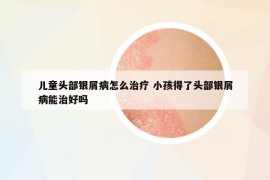 兒童頭部銀屑病怎么治療 小孩得了頭部銀屑病能治好嗎