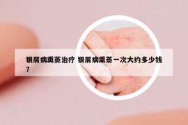 銀屑病熏蒸治療 銀屑病熏蒸一次大約多少錢(qián)?