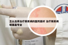 怎么選擇治療銀屑病的醫(yī)院最好 治療銀屑病哪里最專業(yè)