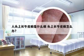 人頭上長(zhǎng)牛皮癬是什么病 頭上長(zhǎng)牛皮癬怎么辦?