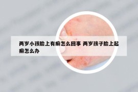 兩歲小孩臉上有癬怎么回事 兩歲孩子臉上起癬怎么辦