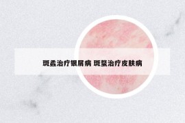 斑蟊治療銀屑病 斑蝥治療皮膚病