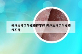 光療治療了牛皮癬行不行 光療治療了牛皮癬行不行