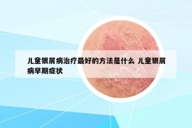 兒童銀屑病治療最好的方法是什么 兒童銀屑病早期癥狀