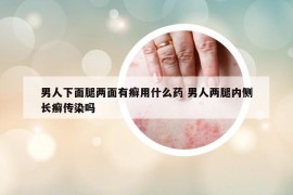 男人下面腿兩面有癬用什么藥 男人兩腿內(nèi)側(cè)長(zhǎng)癬傳染嗎