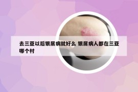 去三亞以后銀屑病就好么 銀屑病人都在三亞哪個村