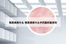 銀屑病用什么 銀屑病用什么中藥最好最有效