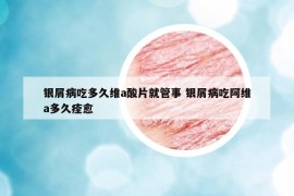 銀屑病吃多久維a酸片就管事 銀屑病吃阿維a多久痊愈