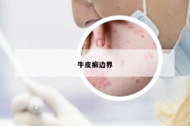 牛皮癬邊界
