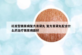 紅皮型銀屑病復(fù)方青黛丸 復(fù)方青黛丸配合什么藥治療銀屑病最好