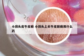 小孩頭皮牛皮癬 小孩頭上長(zhǎng)牛皮膚癬用什么藥