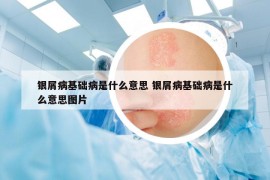 銀屑病基礎(chǔ)病是什么意思 銀屑病基礎(chǔ)病是什么意思圖片