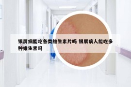 銀屑病能吃各類維生素片嗎 銀屑病人能吃多種維生素嗎