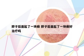 脖子后面起了一塊癬 脖子后面起了一塊癬好治療嗎
