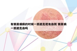有銀屑病癢的時(shí)候一抓就出現(xiàn)有血斑 銀屑病一抓就出血嗎