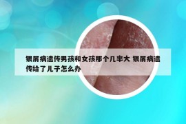 銀屑病遺傳男孩和女孩那個(gè)幾率大 銀屑病遺傳給了兒子怎么辦