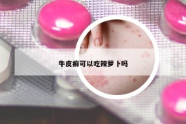 牛皮癬可以吃辣蘿卜嗎