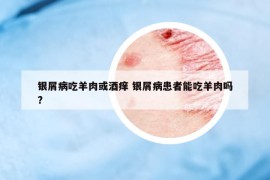 銀屑病吃羊肉或酒癢 銀屑病患者能吃羊肉嗎?