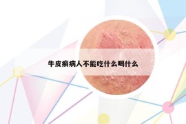牛皮癬病人不能吃什么喝什么